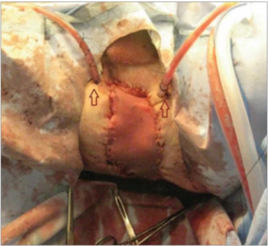 Flap’s position after its defi nitive fi xation; note that two drains were placed to prevent fl uid accumulation.