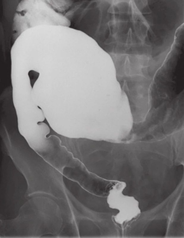 Irigografický obraz rektosigmoideální formy H. ch. u druhého pacienta
Fig. 4: Contrast barium study of rectosigmoid form of HD in the second patient