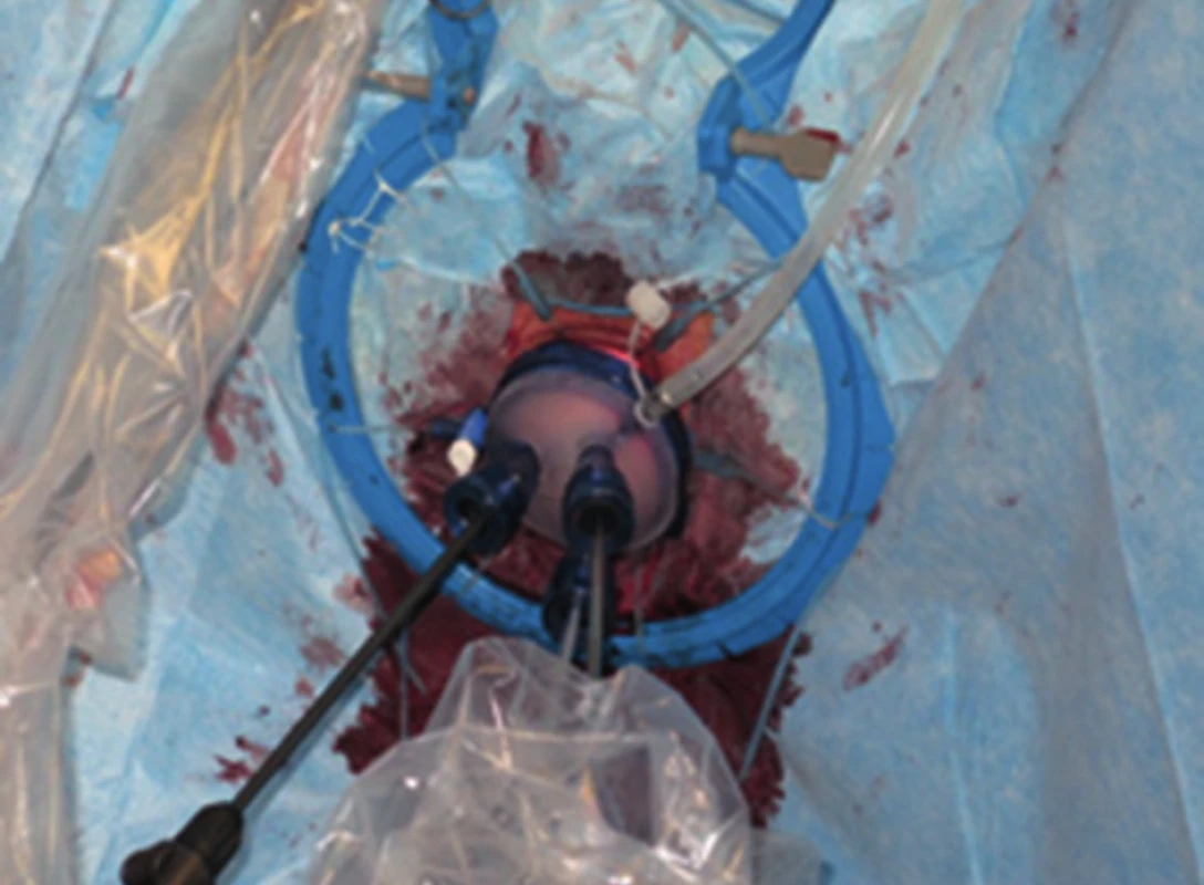 TAMIS port zavedený po protětí rekta v místě distální resekční linie
Fig. 2: TAMIS port inserted after cutting a rectum at the level of distal resection margin
Autor: T. Grolich