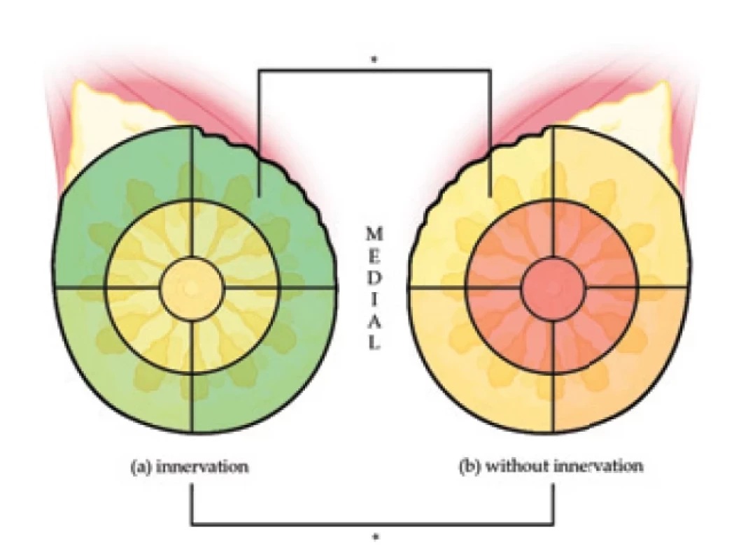 Heat map for area-specifi c pooled SMWT rod size in breasts with surgical reinnervation (A) and without surgical reinnervation (B). There is a signifi cant diff erence in sensory recovery in the overall and upper-medial mastectomy skin. SD – standard deviation