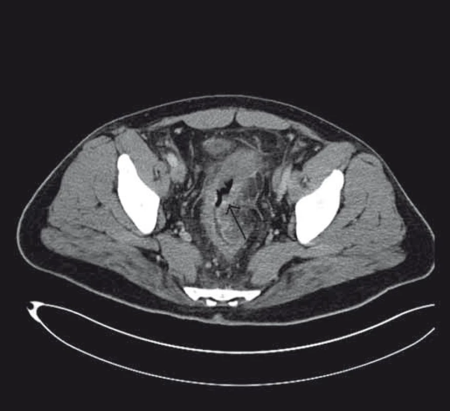 Stenóza střeva při CT zobrazení.
Fig. 2. Stenosis of the bowel on the CT scan.