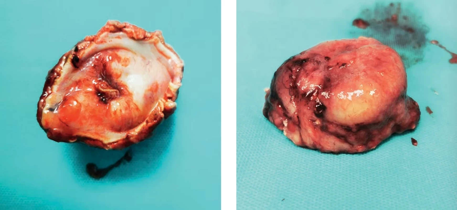  Macroscopically, the tumour appears as an exophytically and polypoidly growing semicircular  mass measuring 6.5 × 5 × 3 cm.  Makroskopicky, půlkruhově exofyticky a polypoidně rostoucí nádor o rozměrech 6,5 × 5 × 3 cm.
