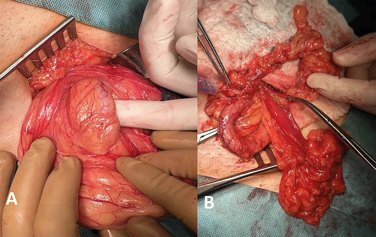 Peroperačný nález </br> Fig. 3: Intraoperative findings