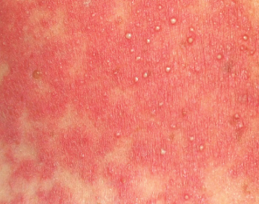 Výsev drobných pustul na erytematózní bázi v dekoltu