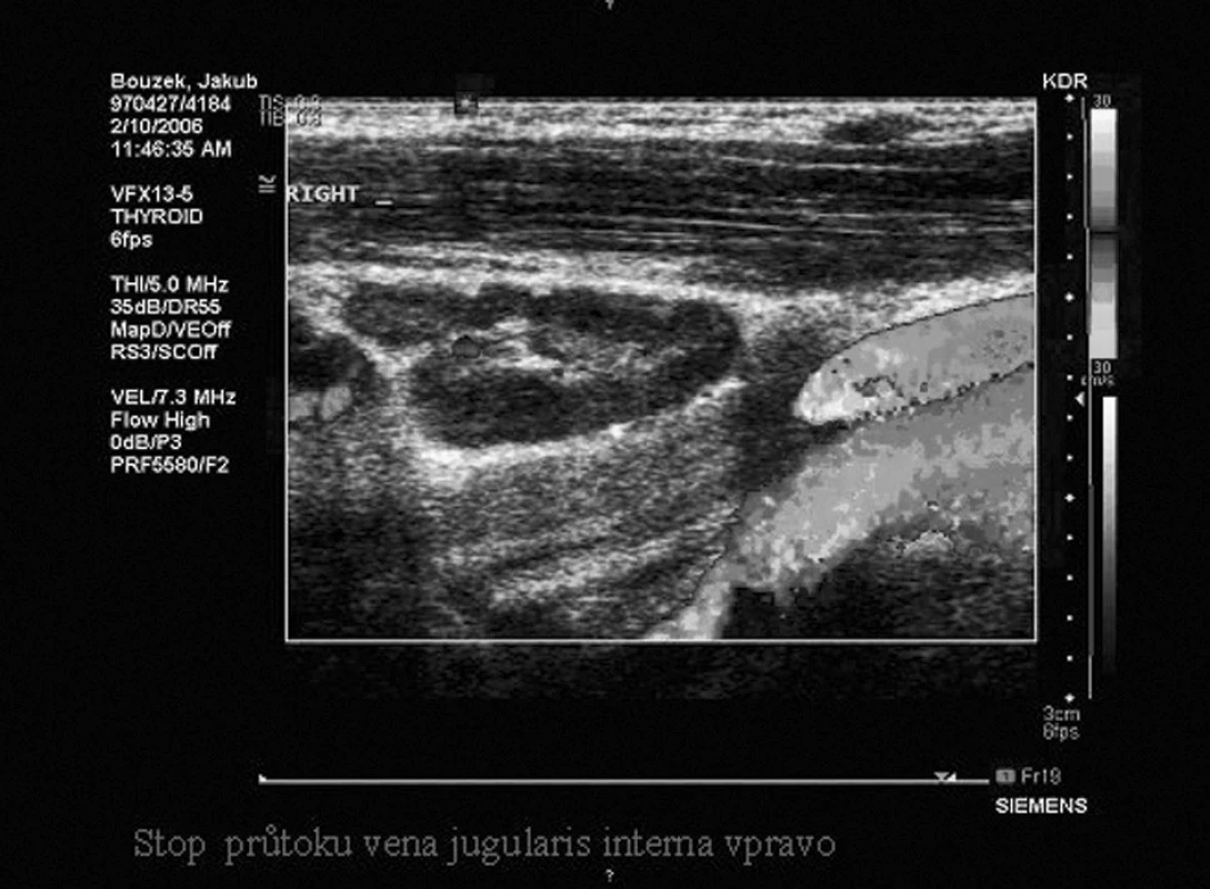 UZ doppler pravé VJI.