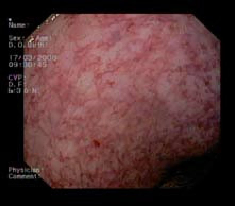 Sliznica rekta 24 mesiacov po ukončení liečby argón plazma koaguláciou.
Fig. 5. Rectum mucosa 24 months after termination of argon plasma coagulation treatment.