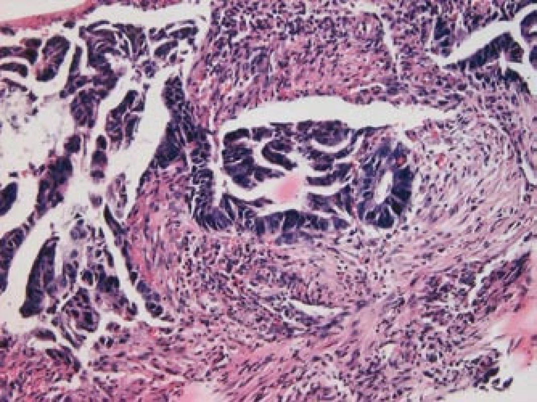 Invazivní adenokarcinom, barvení hematoxylin-eozin, zvětšení 200krát (laskavostí prim. MUDr. Ladislavy Kučerové, Ústav patologie LF UP a FN Olomouc).