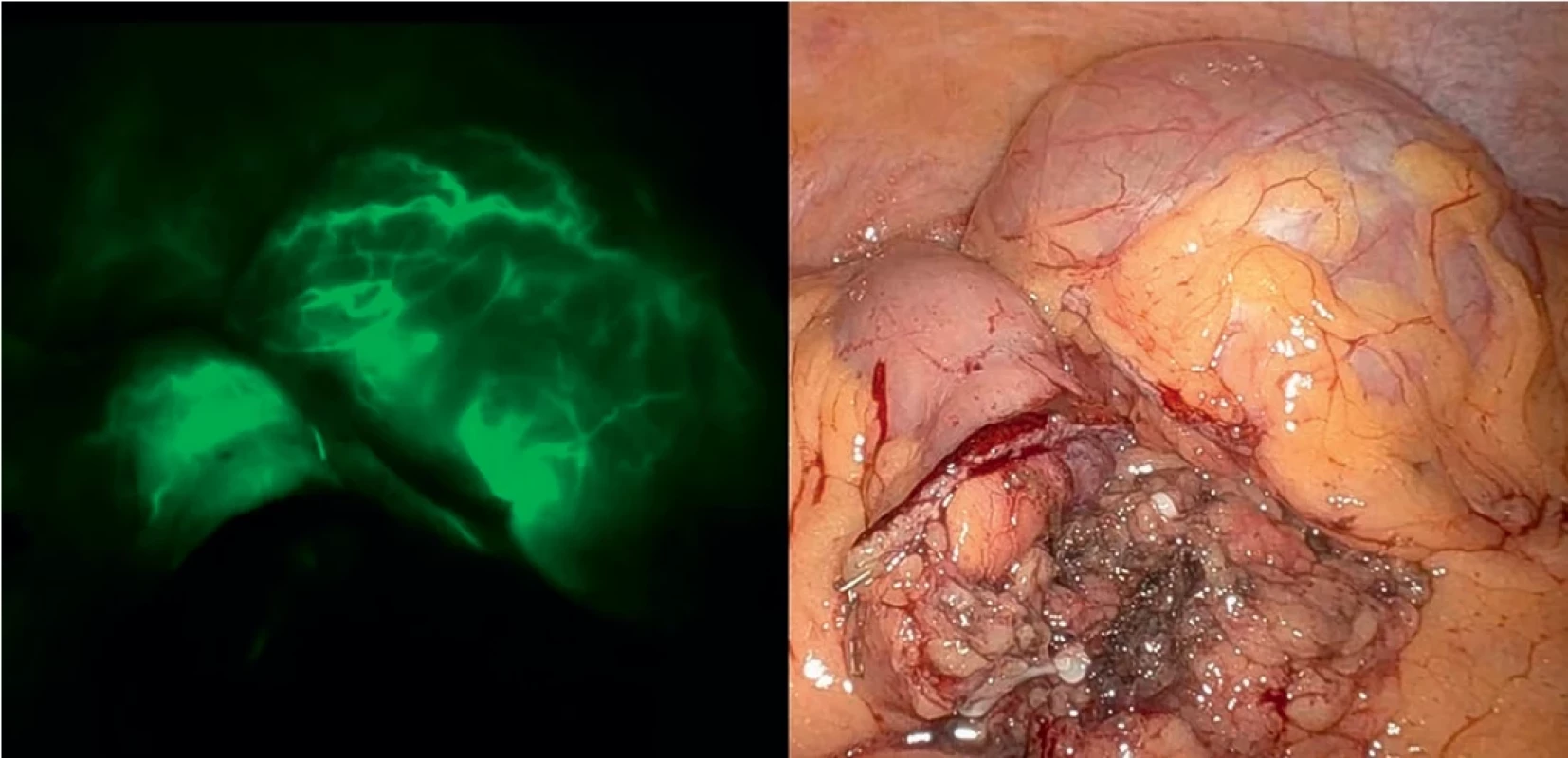  Užití indocyaninové zeleně k ověření prokrvení resekčních okrajů.  Indocyanine green using for post resection margins blood flow verification.