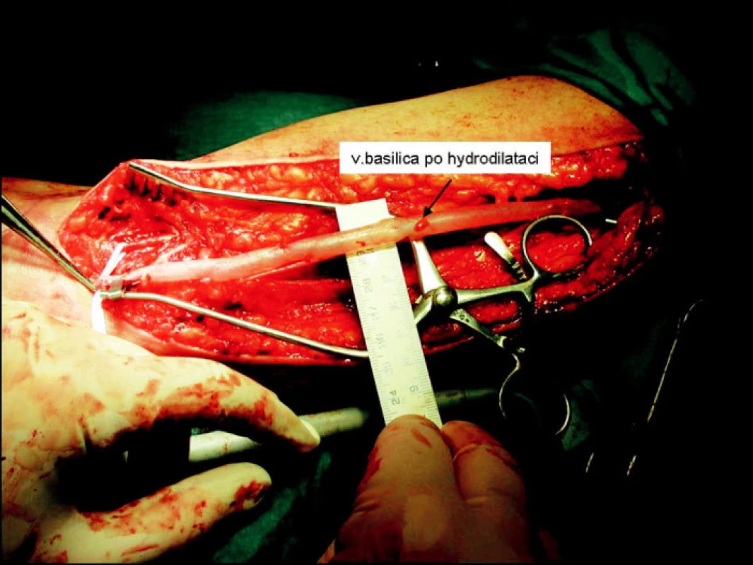 Hydrodilatace vena basilica
Fig. 2. Hydrodilation of the vena basilica