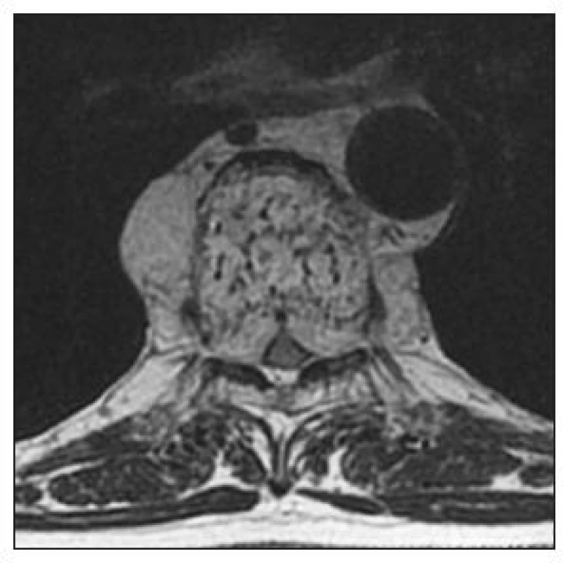 MRI (T2-vážené) v axiální rovině. Průkaz hemangiomu obratle Th7 s propagací paravertebrálně a do kanálu
páteřního
Fig. 2. Axial MRI (T2-weighted). Detection of hemangioma of TH7 with paravertebral spread into the spinal canal