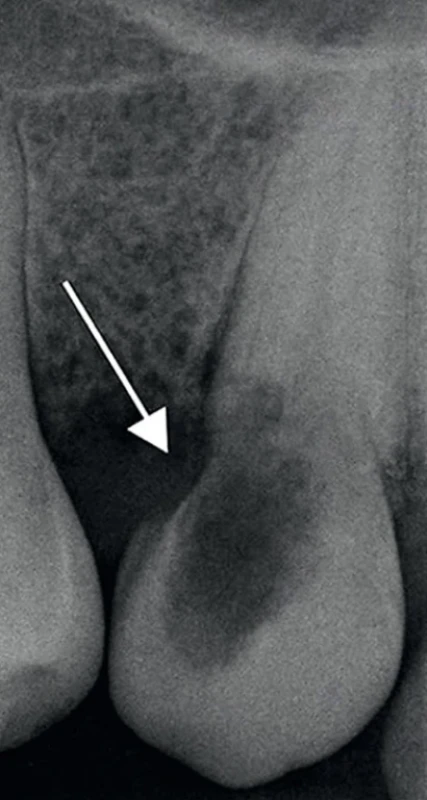 Externá cervikálná resorpcia zuba 23 – päť rokov po ortodontickej terapii. Zdroj: Simona Fritzká. Fig. 4 External cervical resorption of the tooth 23 – five years after orthodontic therapy. Source: Simona Fritzká.