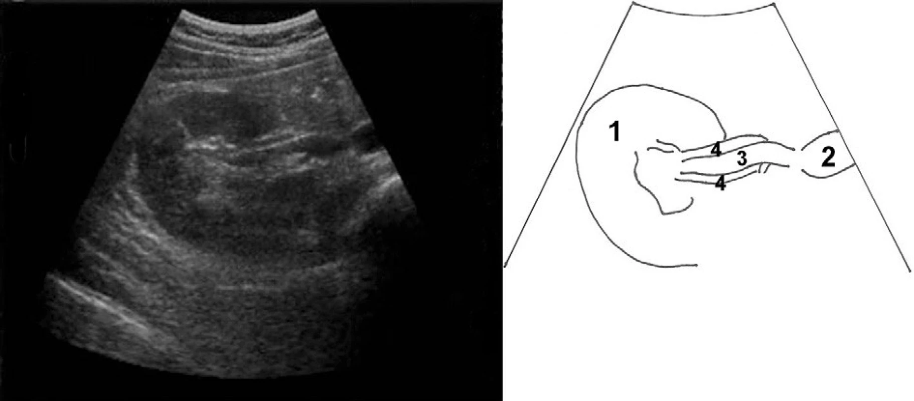 Příčný řez pravou ledvinou se zaměřením na cévní zásobení; 1 – kůra ledviny, 2 – vena cava inferior, 3 – vena renalis l. dx.,
