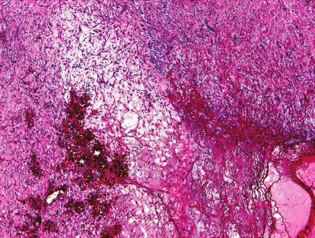 U pseudosarkomatózní myofibroblastické proliferace bývá přítomno objemné myxoidní stroma. HE, 100x
