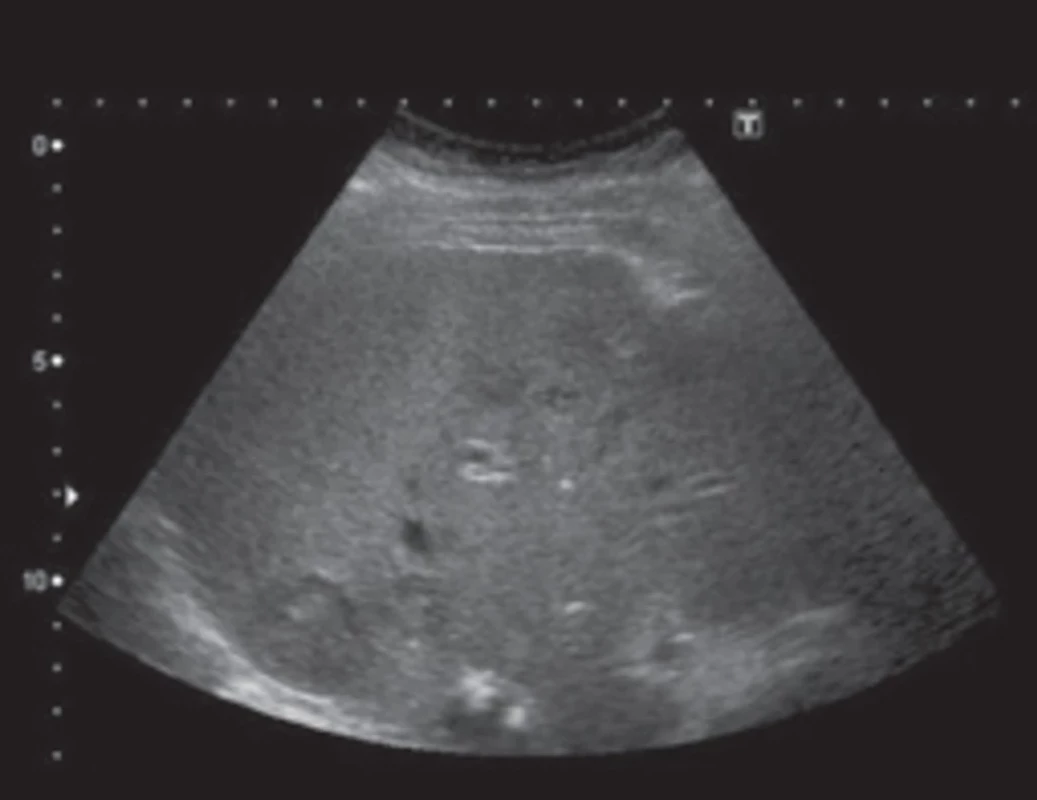 USG snímek jater – štěp jater s vícečetným metastatickým postižením, největší ložisko 75×60 mm. Fig. 3. Liver ultrasound – liver graft with multiple metastatic lesions, largest lesion 75×60 mm.