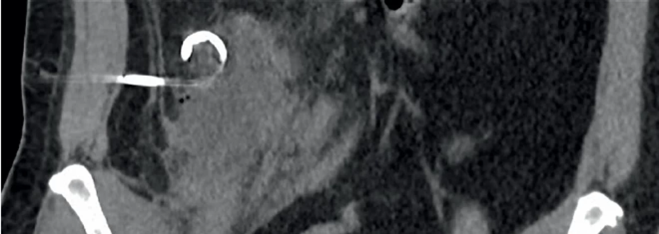  Drén zavedený do abscesu pod CT kontrolou.  A CT guided drainage of the abscess.
