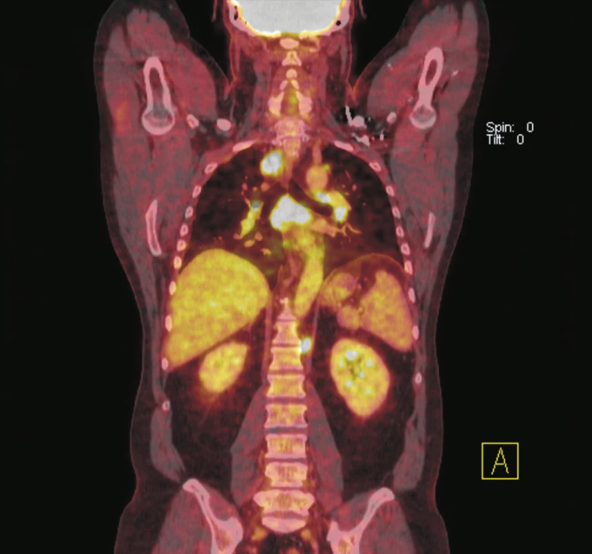 Na fúzovaném koronálním PET/CT řezu lze diferencovat zvýšenou akumulaci <sup>18</sup>F-FDG v lymfatických uzlinách mediastina paratracheálně vpravo, oboustranně bronchopulmonálně, v paketu uzlin subkarinálně a v retroperitoneu v lymfatické uzlině paraaortálně vlevo pod brániční krurou. Vícečetné postižení lymfatických uzlin bylo i v dalších lokalizacích, které nejsou na tomto řezu zastiženy. Biopticky prokázána sarkoidóza.