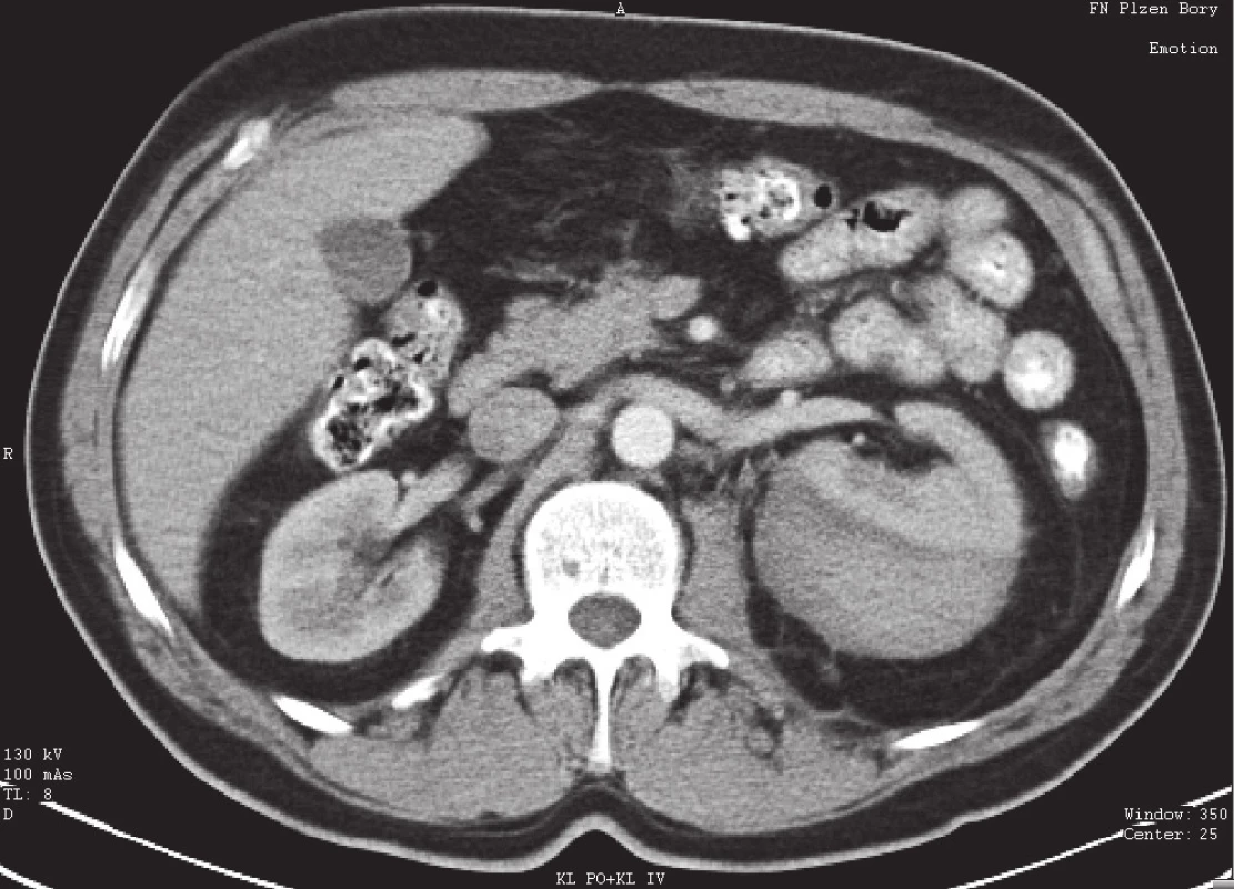 Subkapsulární hematom levé ledviny – I. stupeň poranění dle AAST
Fig. 1. Subcapsular haematoma of the left kidney – grade I. renal injury by AAST