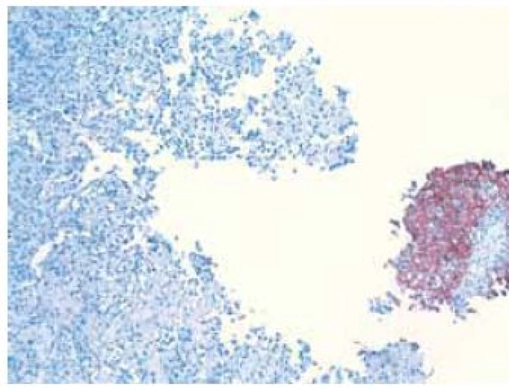 Imunohistochemický dôkaz cytokeratínu typ 7 v epitelovej zložke v pravej časti, osteosarkómový komponent vľavo je negatívny
Fig. 4. Immunohistochemical detection of cytokeratin type 7 in epithelial component on the right part of the picture, osteosarcomatous component in the left is negative