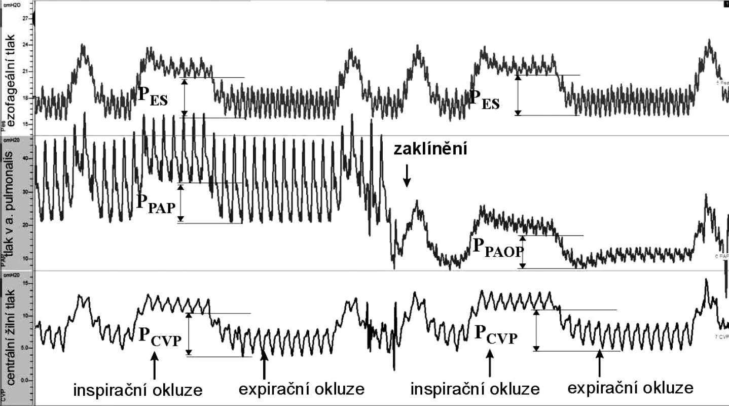Schéma měření – ukázka měření (výstup z programu ScopeWin)
Jednotlivé křivky tlaků (shora dolů: ezofageální tlak, tlak v a. pulmonalis a CVP) byly časově synchronizovány. V době inspiračního plateau a na konci exspiria byly proloženy přímky, a to v nejnižších bodech příslušných tlaků. Rozdíl inspiračních a exspiračních úrovní tlaků představoval změny ezofageálního tlaku (P<sub>ES</sub>), změny centrálního žilního tlaku (P<sub>CVP</sub>), tlaku v a. pulmonalis (P<sub>PAP</sub>) a změny tlaku v zaklínění (P<sub>PAOP</sub>).