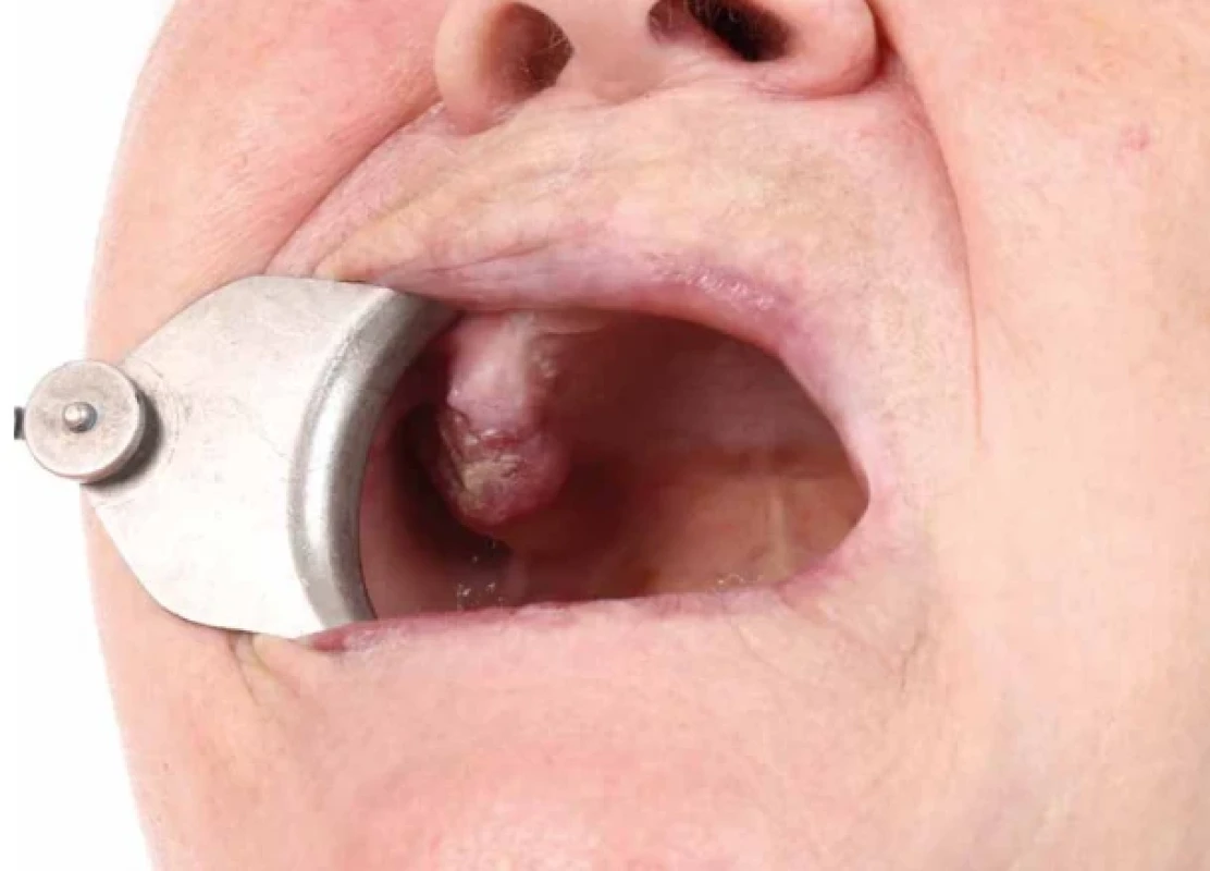 Klinický nález verukózní léze alveolárního výběžku horní čelisti vpravo před potvrzením maligní transformace