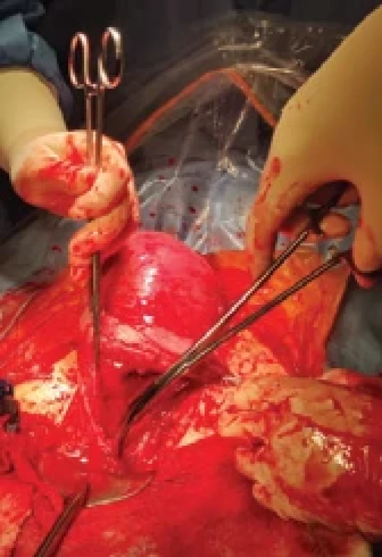 Perioperační nález při císařském řezu v roce 2023. Fig. 5. Perioperative fi ndings during caesarean section in 2023.