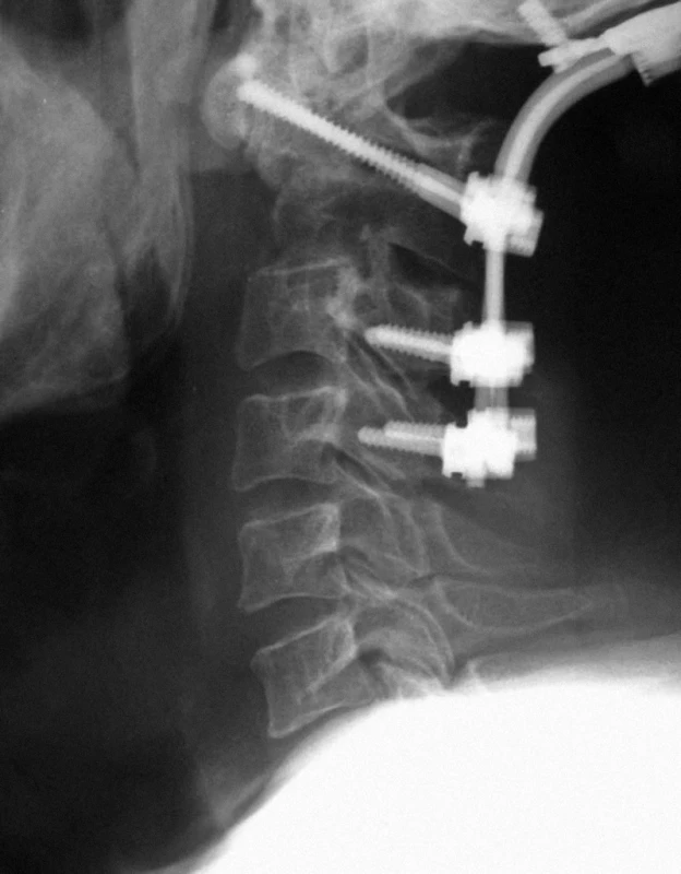 Okcipitocervikální stabilizace u pacienta po zadní dekompresi míchy v oblasti C2 pro metastázu karcinomu tlustého střeva v laterální mase a oblouku C2 s paravertebrálním šířením.