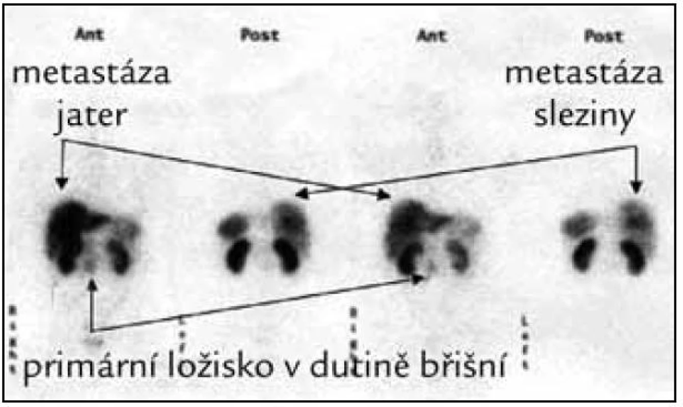 Octreoscan potvrzuje mnohočetná ložiska odpovídající diseminaci tumoru s expresí somatostatinových receptorů potvrzujících diagnózu metastazujícího karcinoidu a ložisko v dutině břišní mimo trávicí trubici suspektní z primární lokalizace tumoru.