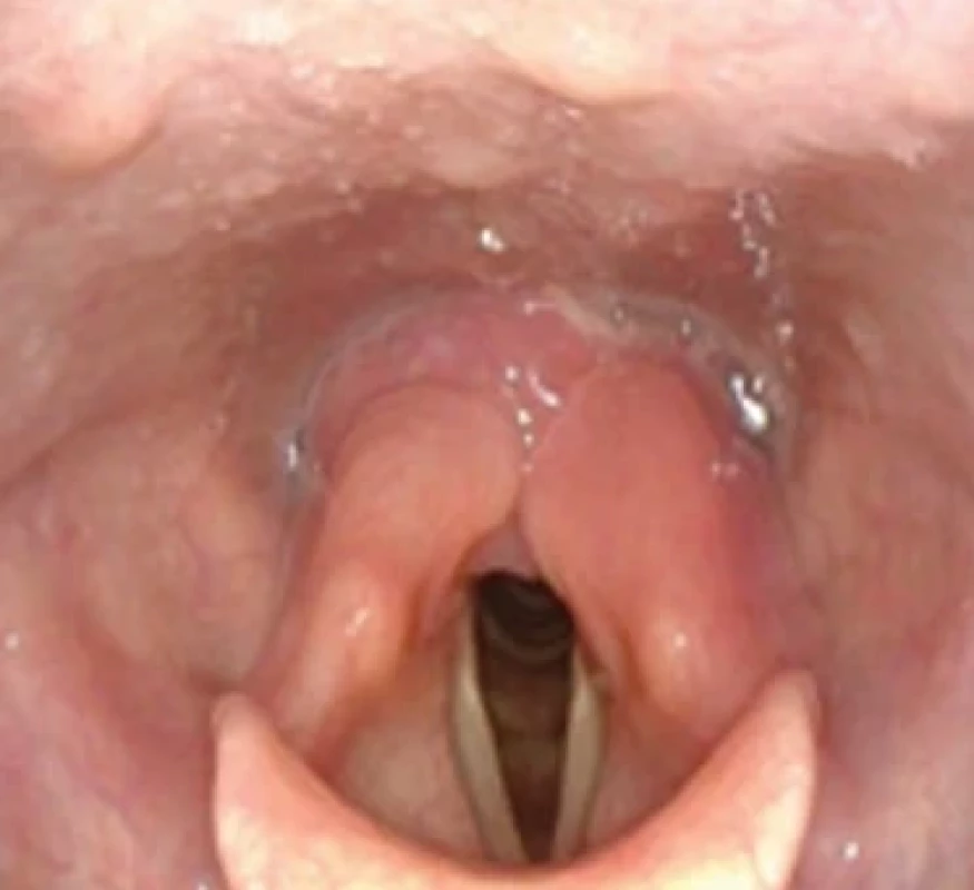 Flexibilná videonazolaryngoskopia: 4. pooperačný deň. 