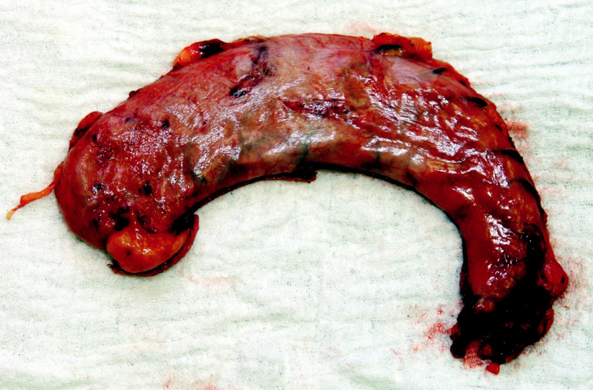 Resekovaná část žaludku
Fig. 5. Resected part of the stomach