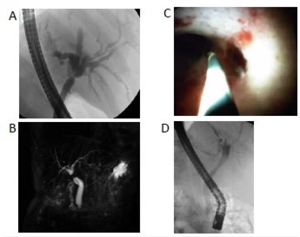Rozdíl ve výsledku intraoperačního a předoperačního
stagingu:
A – předoperační ERCP; B – předoperační MRCP;
C – intraoperační cholangioskopie s postižením odstupu
segmentálních žlučovodů; D – implantace SEMS v rámci
peroperačního ERCP