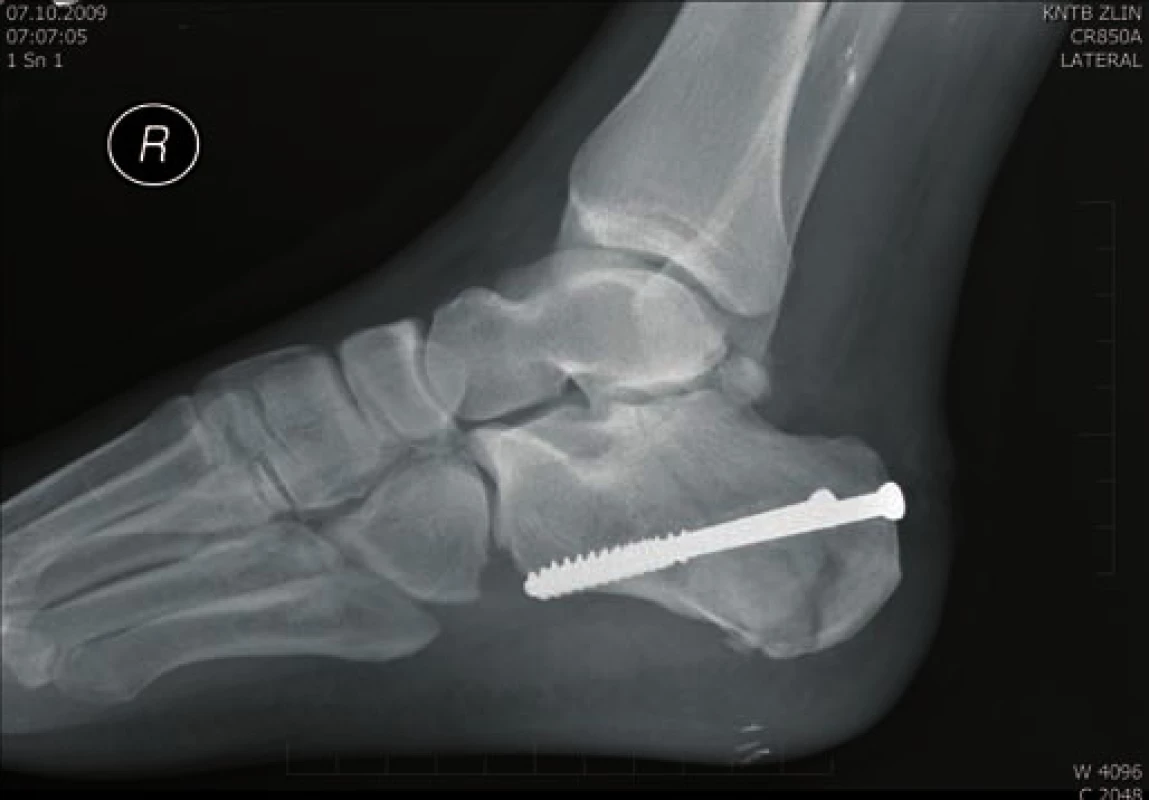 Osteosyntéza AO šrouby - laterální projekce