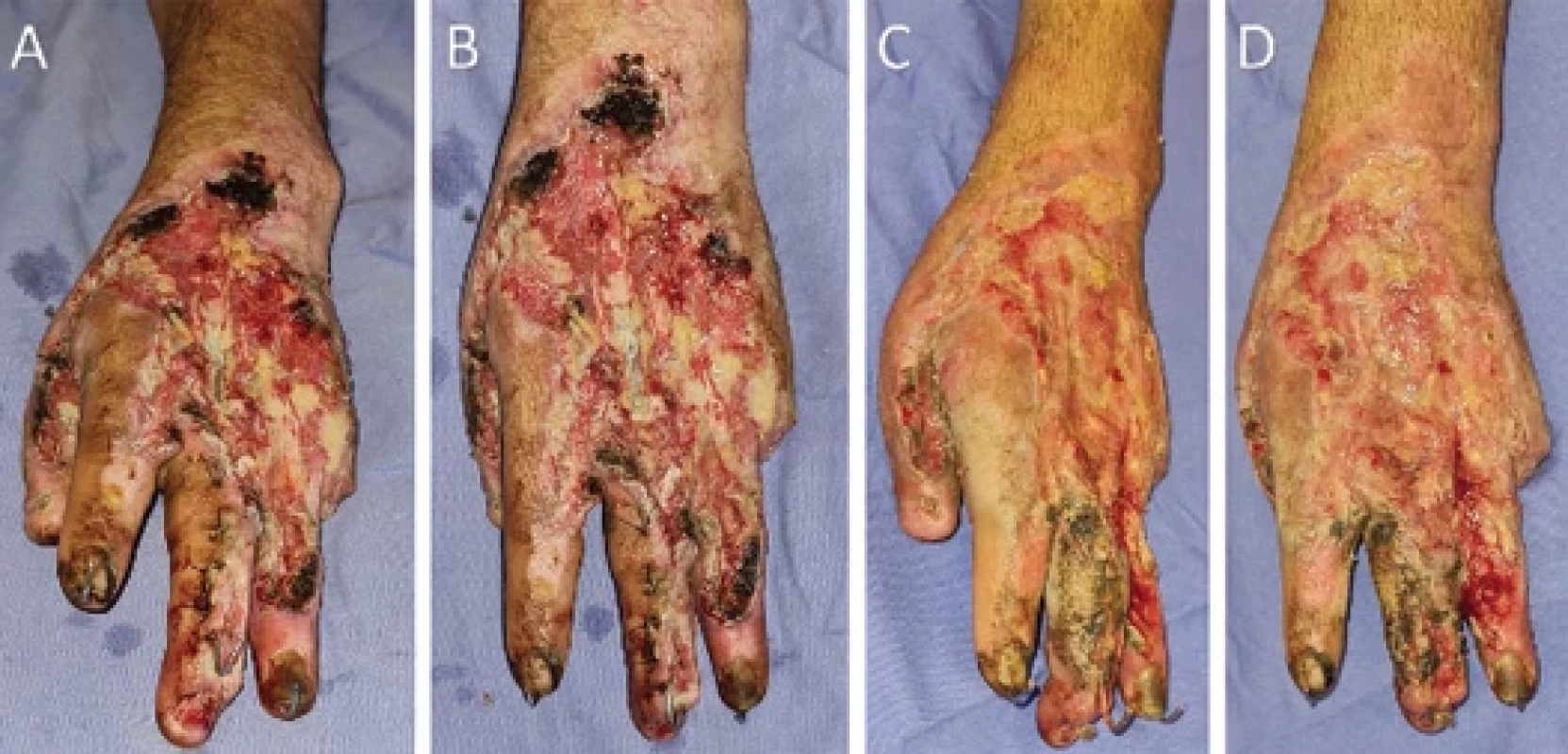 A) Initial appearance of the hand 7 days after the fi rst debridement with fat graft and vacuum dressing, anterior view; B) at this time, the surgical debridement, lipografting, and vacuum dressing procedure were repeated, superior view; C) initial appearance of the hand 7 days after the second debridement with fat graft and vacuum dressing, anterior view; D) the surgical debridement, lipografting, and vacuum dressing procedure were repeated again, superior view.