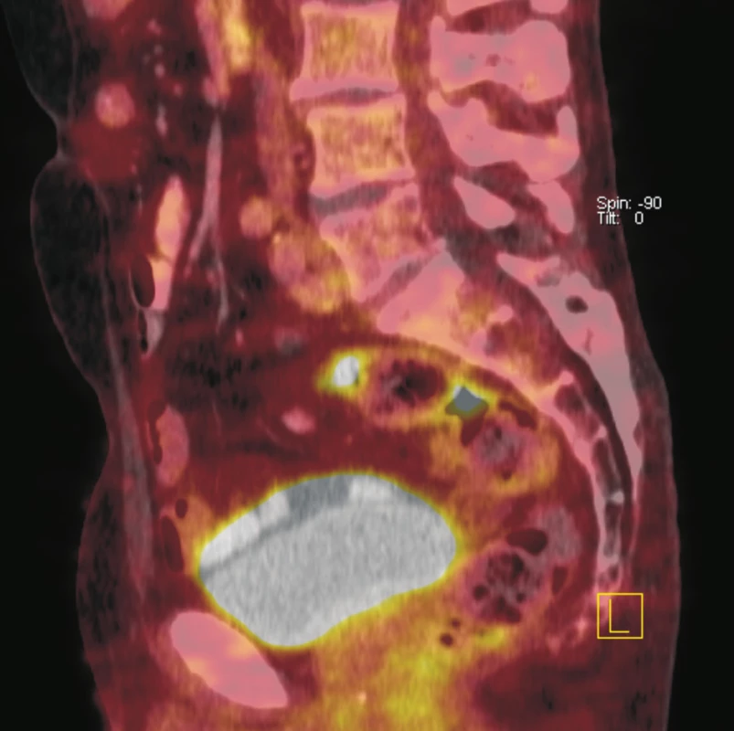 Fúze sagitálních řezů PET a CT. Je patrná fokálně zvýšená akumulace <sup>18</sup>F-FDG ve dvou krátkých úsecích rektosigmoidea. CT bez jednoznačného strukturálního korelátu. Doporučeno endoskopické došetření, které prokázalo polyp tlustého střeva. Histologicky potvrzen tubulovilózní adenom.