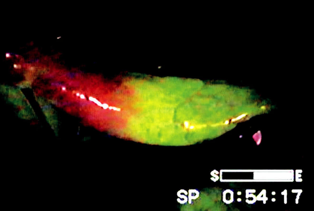 Hranice ischemie střeva vymezená fluoresceinem a UV světlem
Fig. 5. The border of intestinal ischemia marked by fluorescein dye and ultraviolet light