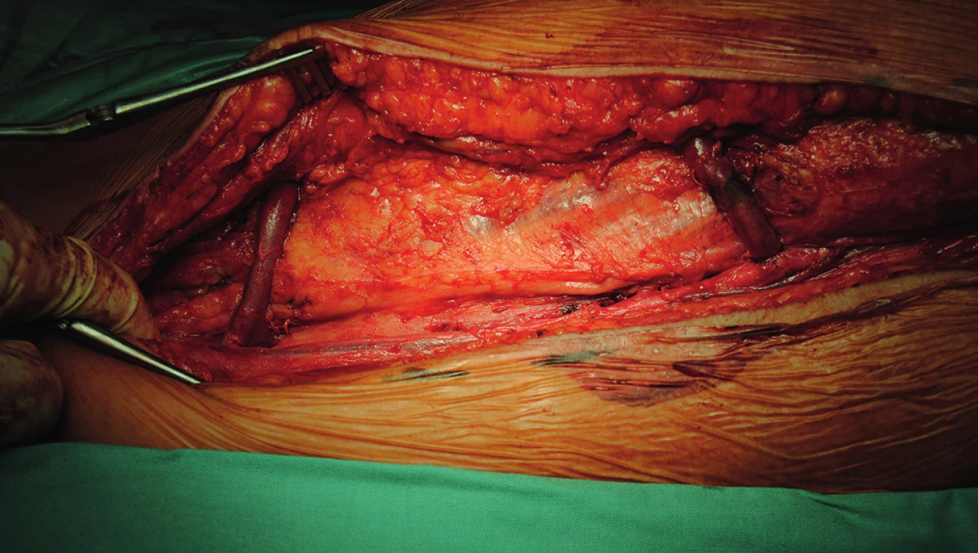 End to side anastomóza mezi graftem a arteria femoralis superficialis
Fig. 2: End to side anastomosis between graft and superficial femoral artery