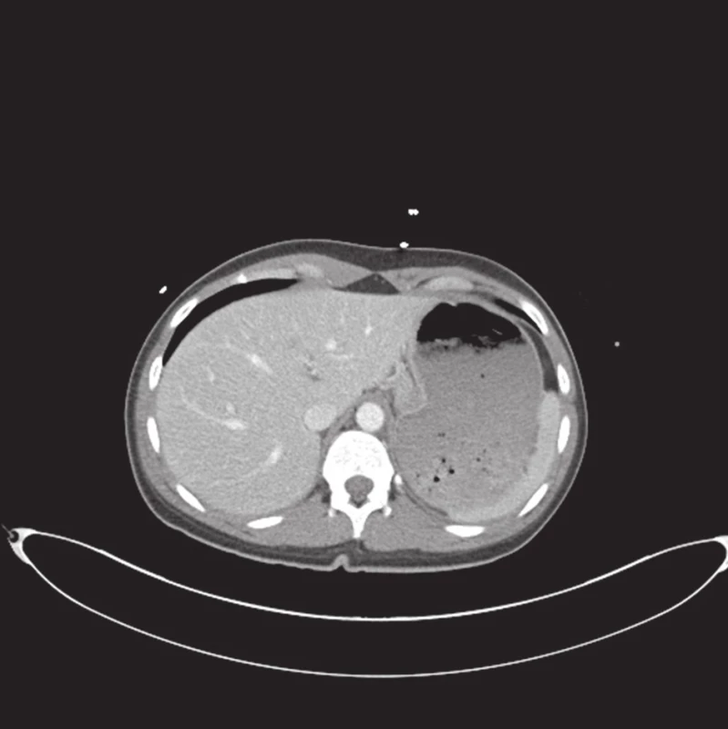 CT vyšetření při příjmu pacientky, bez známek poranění jater
Fig. 1. Initial CT examination, with no signs of liver injury