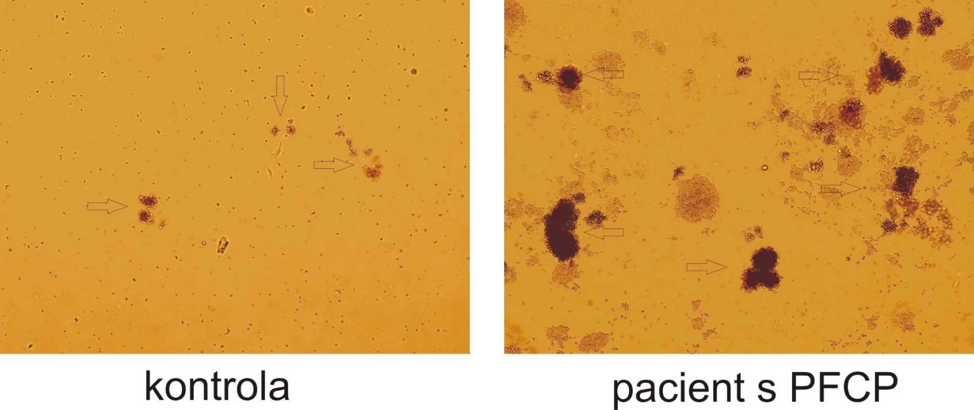 Hypersenzitivita erytroidních progenitorů na EPO in vitro. Výrazný rozdíl růstu erytroidních kolonií (BFU-E) u pacienta s PFCP ve srovnání se zdravou kontrolou při stejné koncentraci EPO (0,12 U/ml). Po 14 dnech kultivace je zřetelný rozdíl jak v počtu, tak ve velikosti erytroidních kolonií  označeny šipkami).