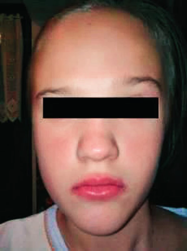 Angioedémy pier, nosa, exantém a asymetria tváre pacientky.
Fig. 1. Angioedema of lips and nose and exanthema with facial asymmetry in patient.