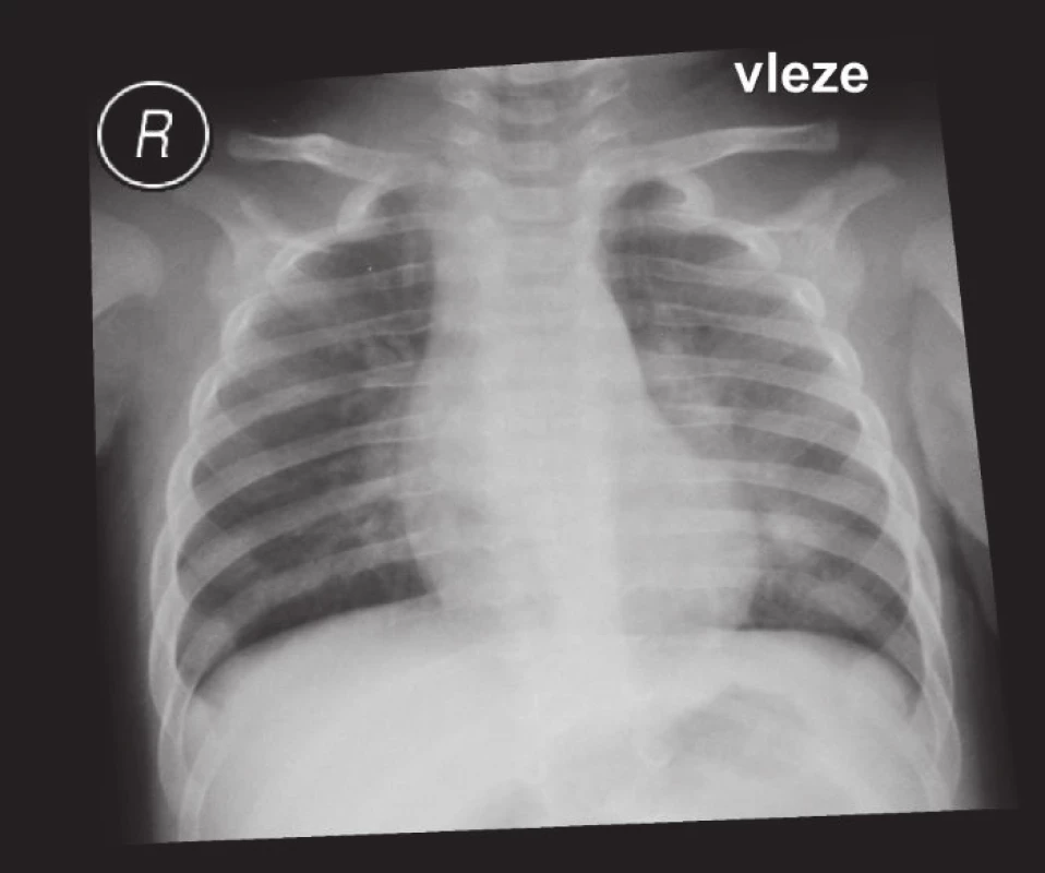 Spalničky – bronchopneumonie.
Fig. 2. Measles – pneumonia.