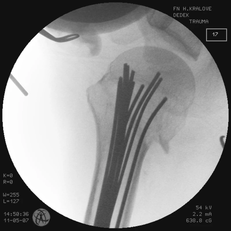 RTG obraz po transfixaci zlomeniny K-dráty vyplňujícími celou dřeňovou dutinu – stav po ukončení operace u pacienta č. 2
Fig. 6. X-ray view following the fracture transfixation with K- wires filling the whole medullar cavity – the patient     No. 2 condition after completion of the procedure