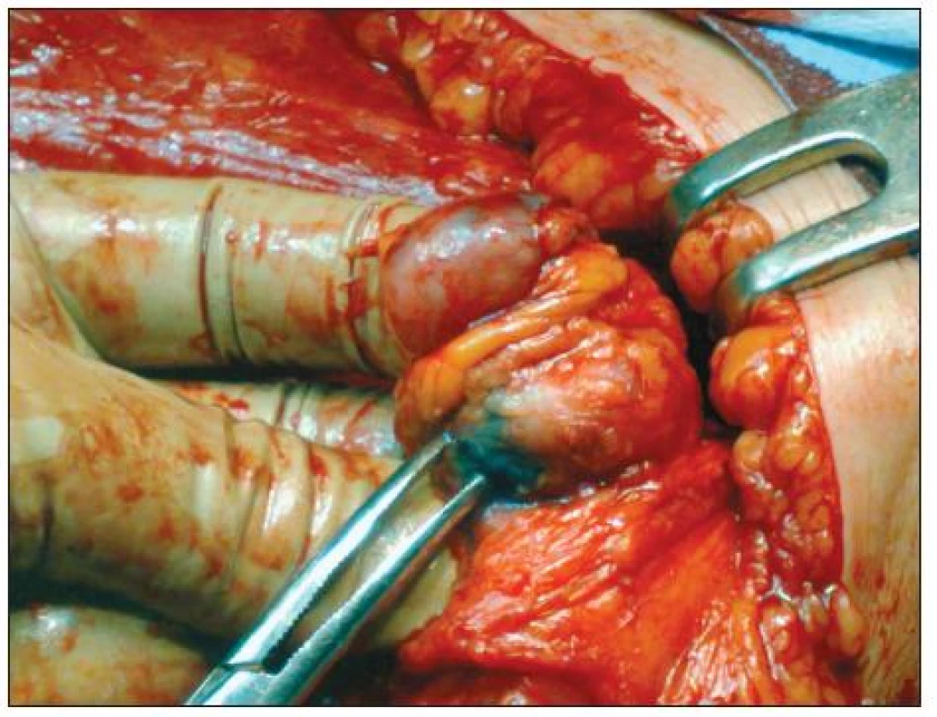 1. Exstirpácia SU pri ablácii prsníka po aplikácii systémovej liečby
Fig. 1. Exstirpation of the sentinel lymph node during the breast ablation procedure following administration of systemic therapy