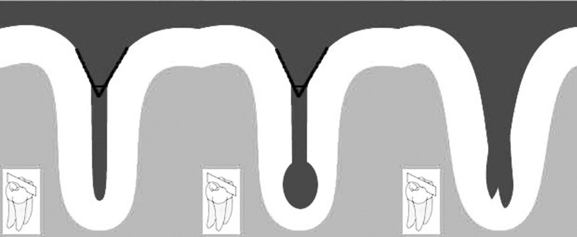 Typy fisur (http://www.scielo.org.ve)