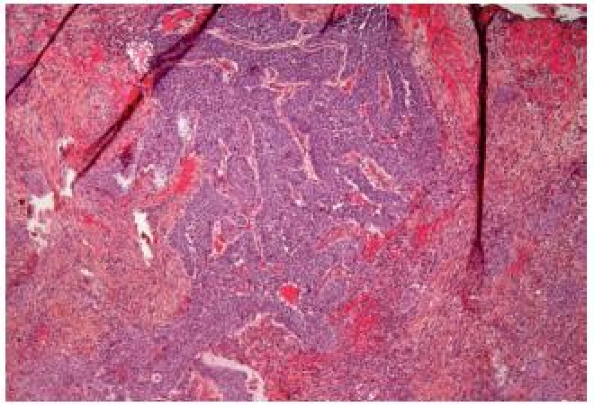 Inverted UC infiltrating deeply into the lamina propria.