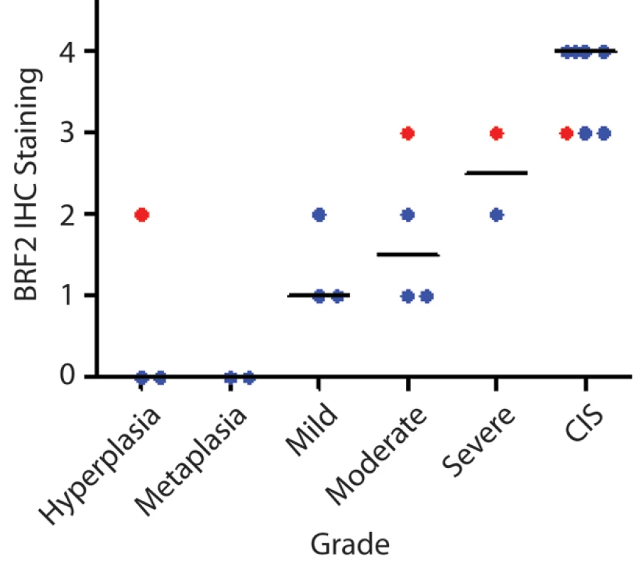 BRF2 expression in SqCC precancerous stages.
