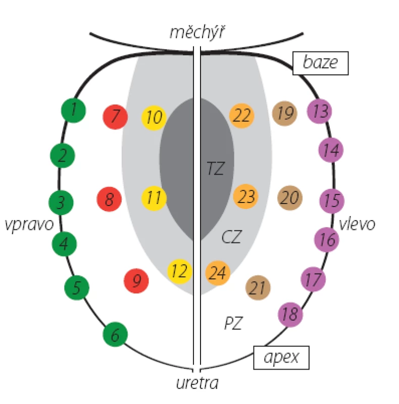 Schéma rozmístění vzorků při saturační biopsii prostaty
TZ – tranzitorní zóna, CZ – centrální zóna, PZ – periferní zóna
Fig. 1. Localization of biopsy cores in saturation prostate biopsy
TZ – transition zone, CZ – central zone, PZ – peripheral zone
