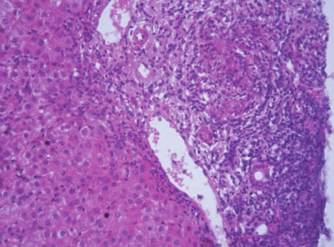 Obraz těžké chronické aktivní hepatitidy s nápadným rozšířením portálního pole a těžkou periportální hepatitidou (výrazné piece-meal nekrózy) u 11letého chlapce s AIH 1. typu.
Fig. 7. A picture of severe chronic active hepatitis with conspicuously extended portal field and severe periportal hepatitis (marked piece-meal necroses) in an 11-year boy with AIH of 1st type.