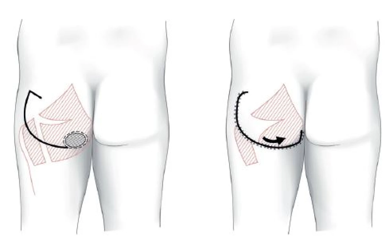 Ischiadický dekubitus – muskulokutánní lalok m. gluteus maximus
Fig. 1: Ischial pressure ulcer – gluteus maximus musculocutaneus flap