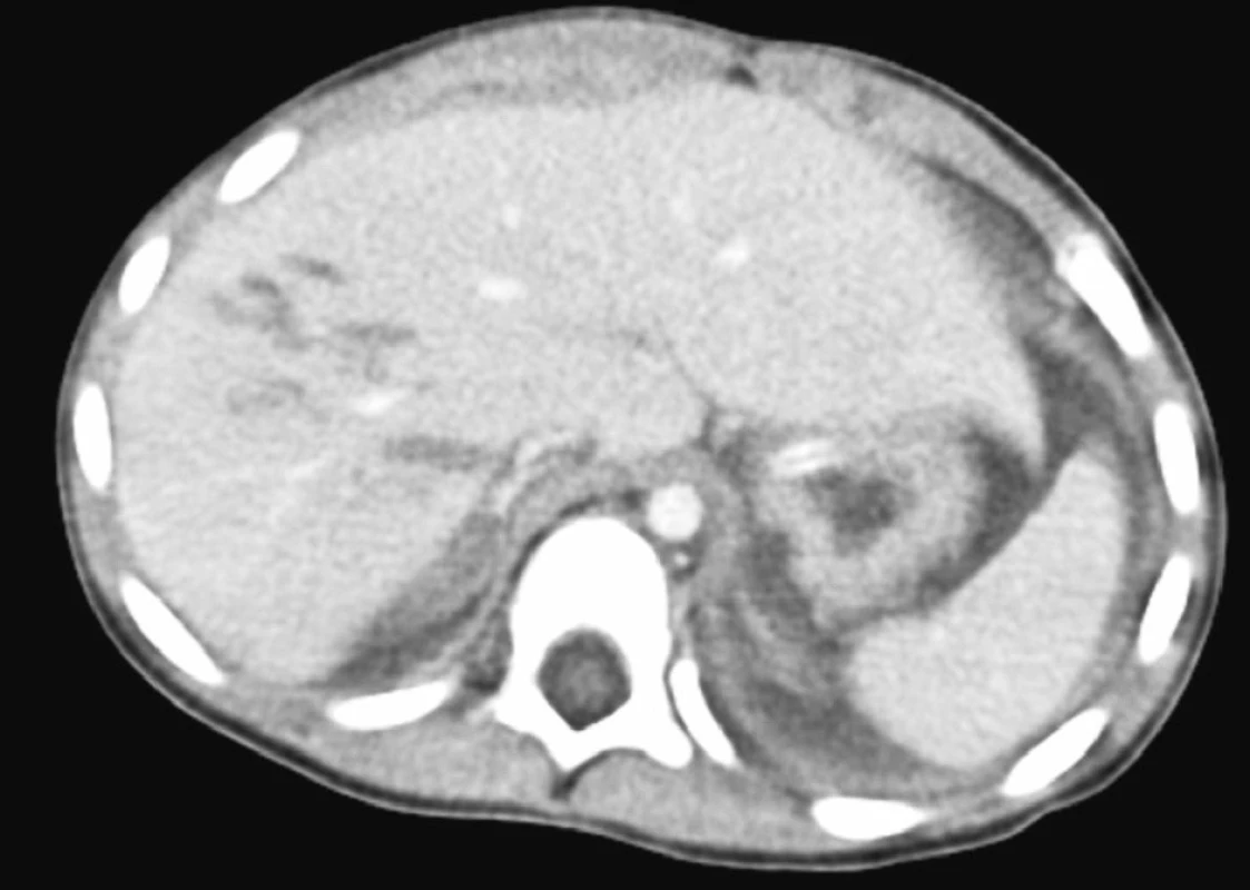 CT obraz kontuze jater
Fig. 4. CT view of liver contusion