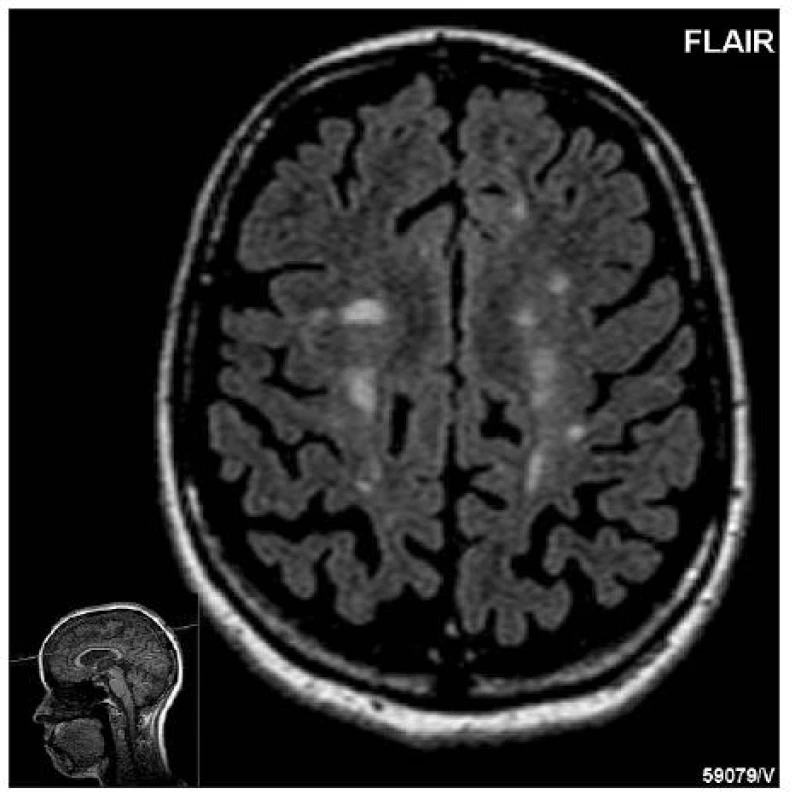 Typický obraz chronické progrese s ložisky i atrofií CNS, 42letá žena po 18 letech průběhu RS.
(Zapůjčeno laskavostí prof. MUDr. Z. Seidla, CSc., ved. odd. MRI Radiodiagnostické kliniky 1. LF UK a VFN v Praze)