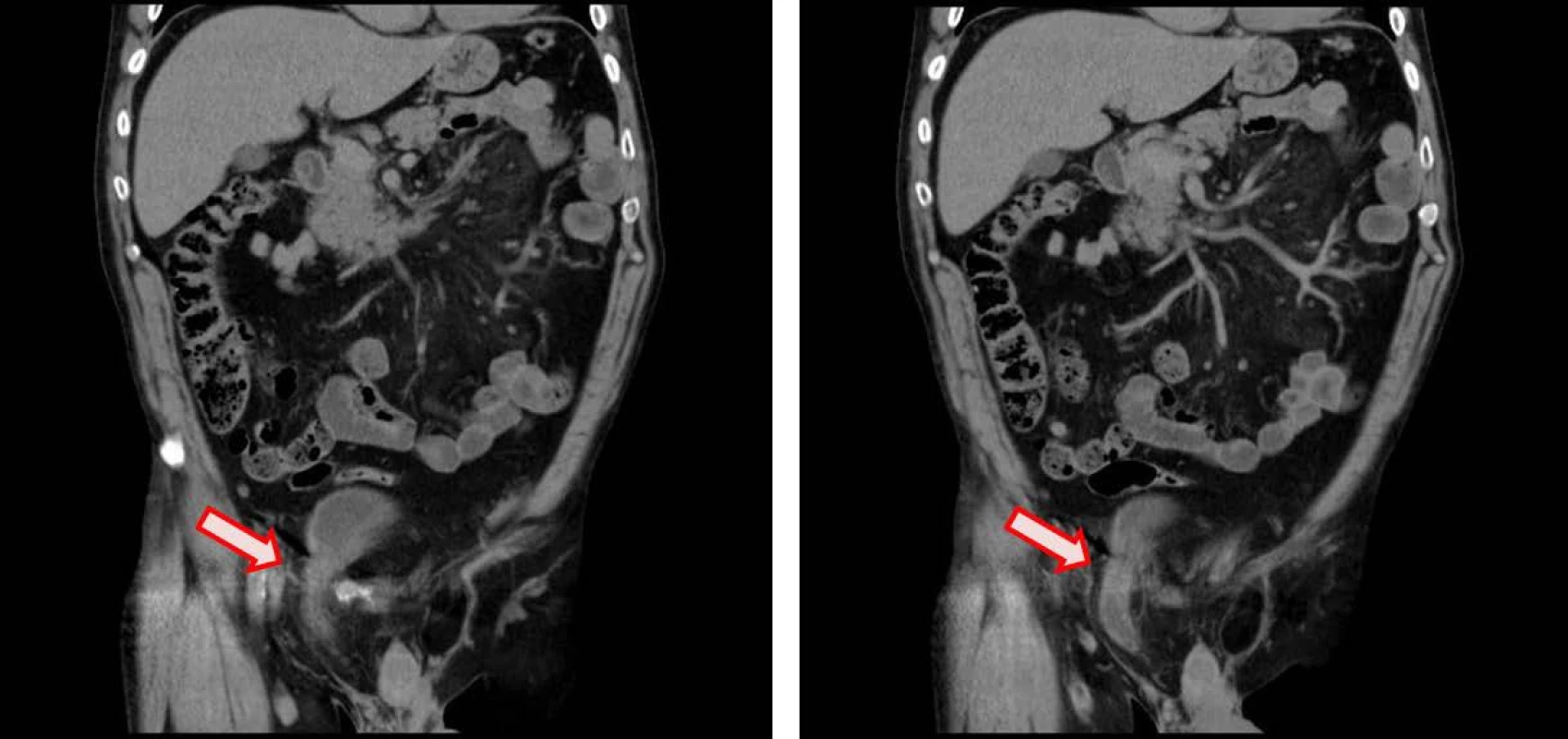 CT koronární řez – herniace močového měchýře do pravého třísla (velikost 48x28 mm)
Fig. 1. CT coronal plane – inguinal bladder herniation (size 48x28 mm)
